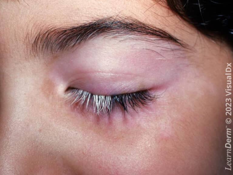 The periorbital depigmentation and light pink patches of vitiligo could be easily missed in this light-skinned patient, though the associated poliosis in the eyelash accentuates the color loss.