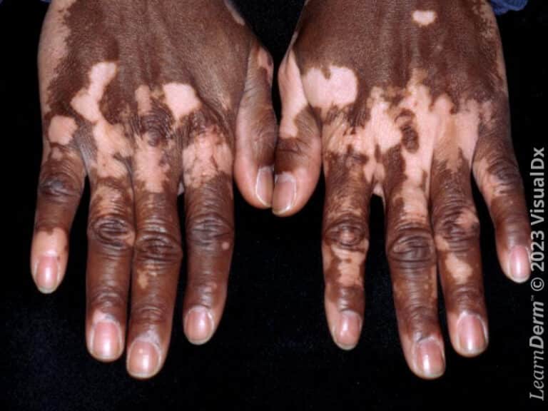 The depigmentation of vitiligo is striking in this very dark-skinned patient.