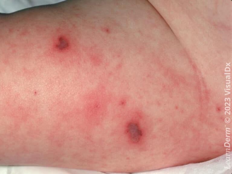 La coloration violacée caractéristique du purpura est manifeste chez cet(te) enfant à la peau claire.
