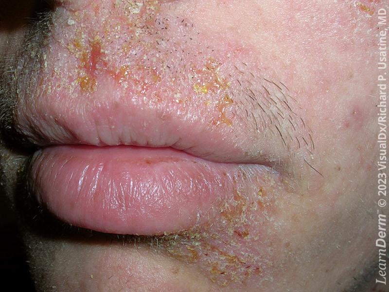 Primary and Secondary Skin Infections