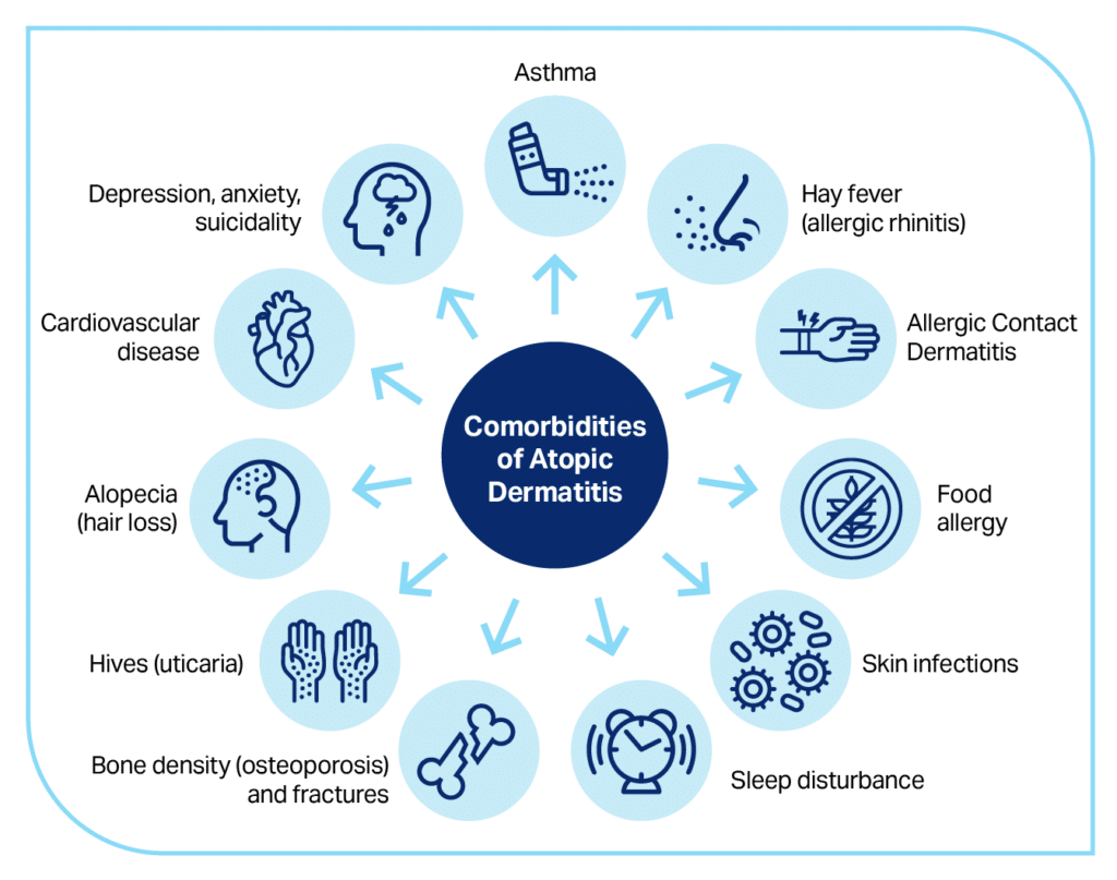 Association with Other Atopic Diseases