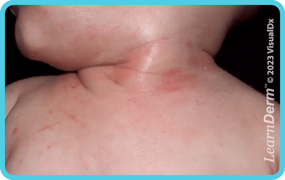 Atopic Dermatitis