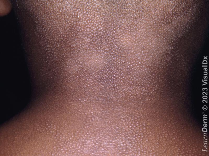 1. Introduction to Atopic Dermatitis