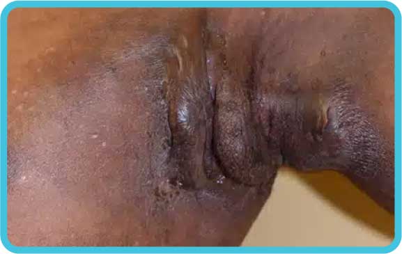 Understanding Moderate Hidradenitis Suppurativa (Coming Soon)